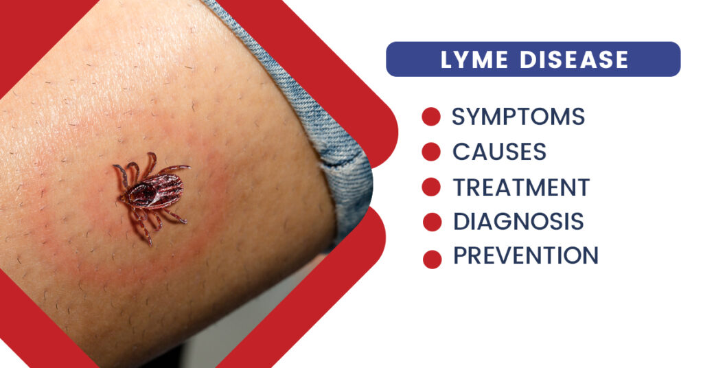 Lyme Disease Symptoms, Causes, Diagnosis, Prevention, and Treatment