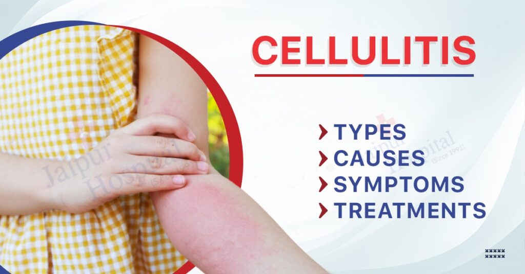 Cellulitis Types, Causes, Symptoms, and Treatments