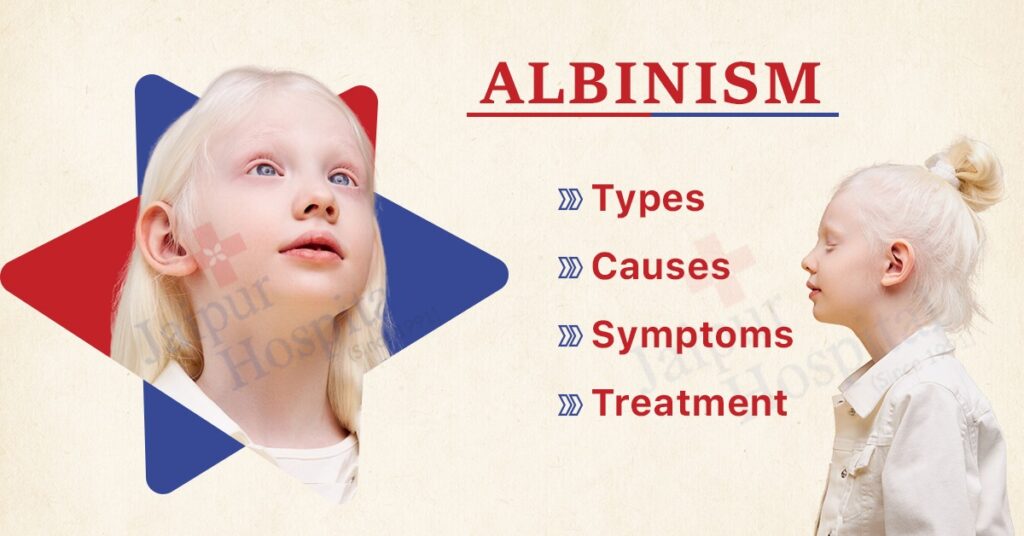 Albinism: Types, Causes, Symptoms and Treatment - Jaipur Hospital