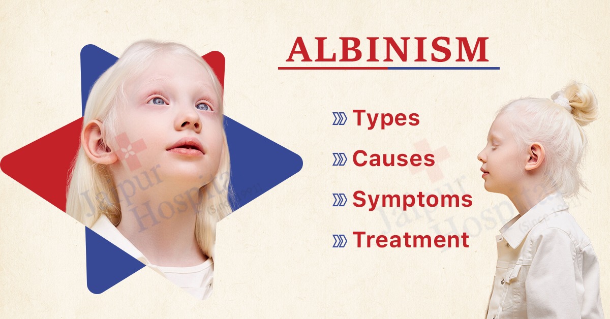 Albinism Types, Causes, Symptoms and Treatment