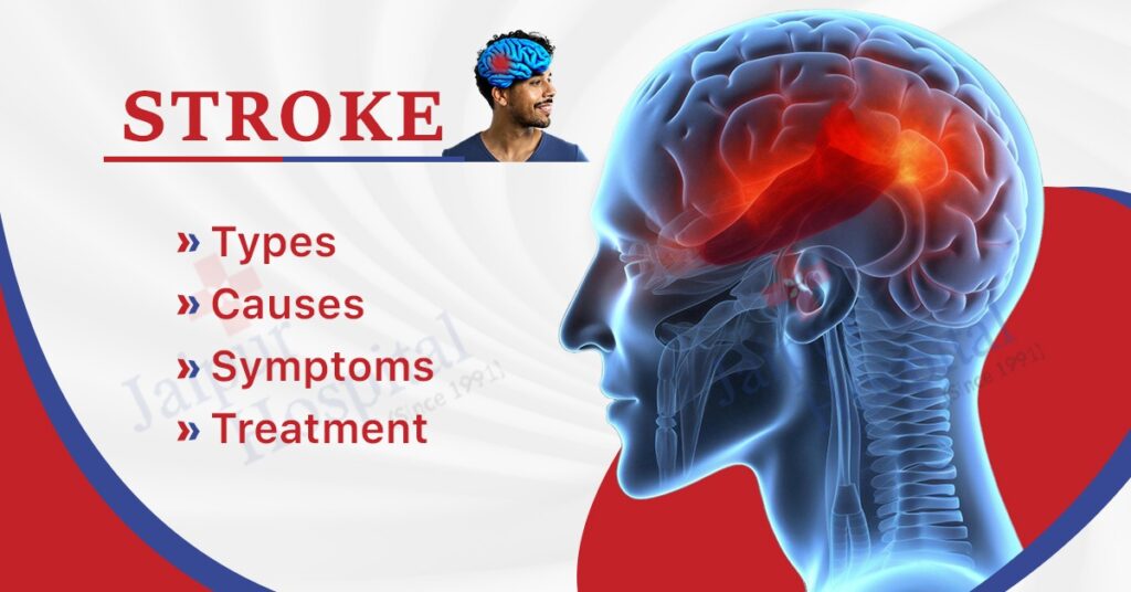 Stroke: Types, Causes, Symptoms & Treatment - Jaipur Hospital