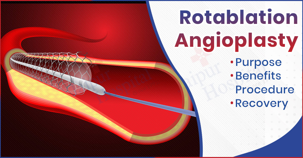 Rotablation Angioplasty