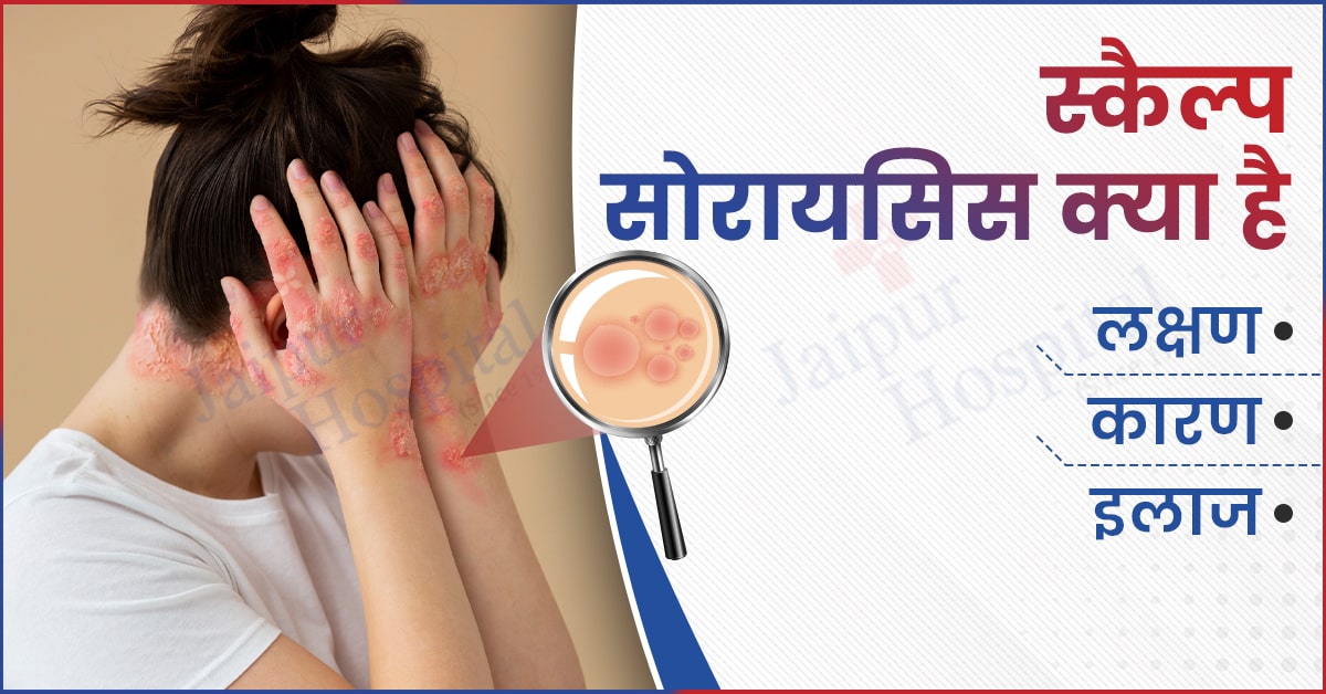 स्कैल्प सोरायसिस