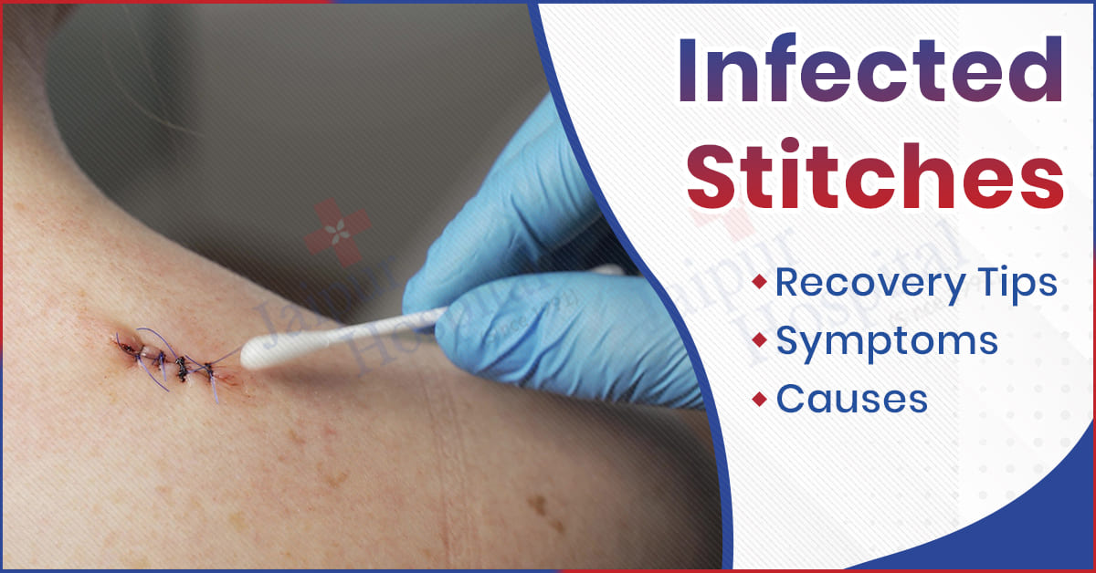 Infected Stitches