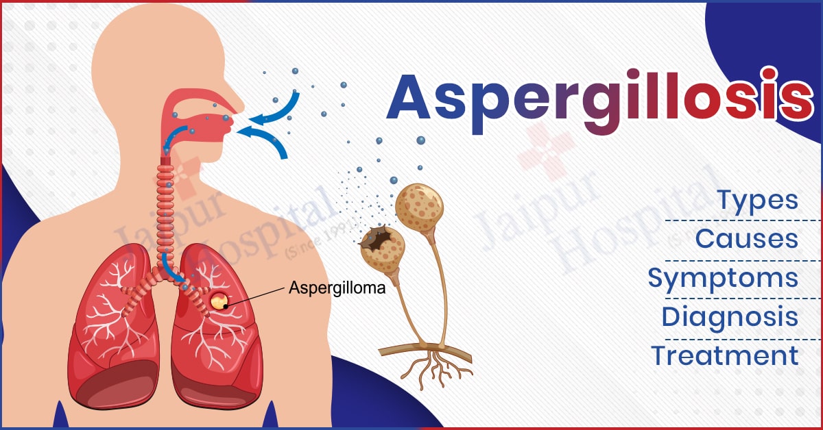 Aspergillosis